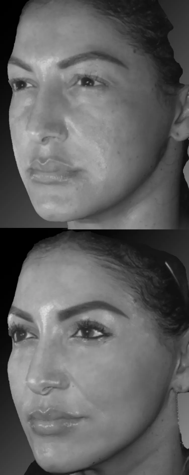 Before and after eyelid rejuvenation showing improved eye openness and smoother eye-cheek transition with natural results