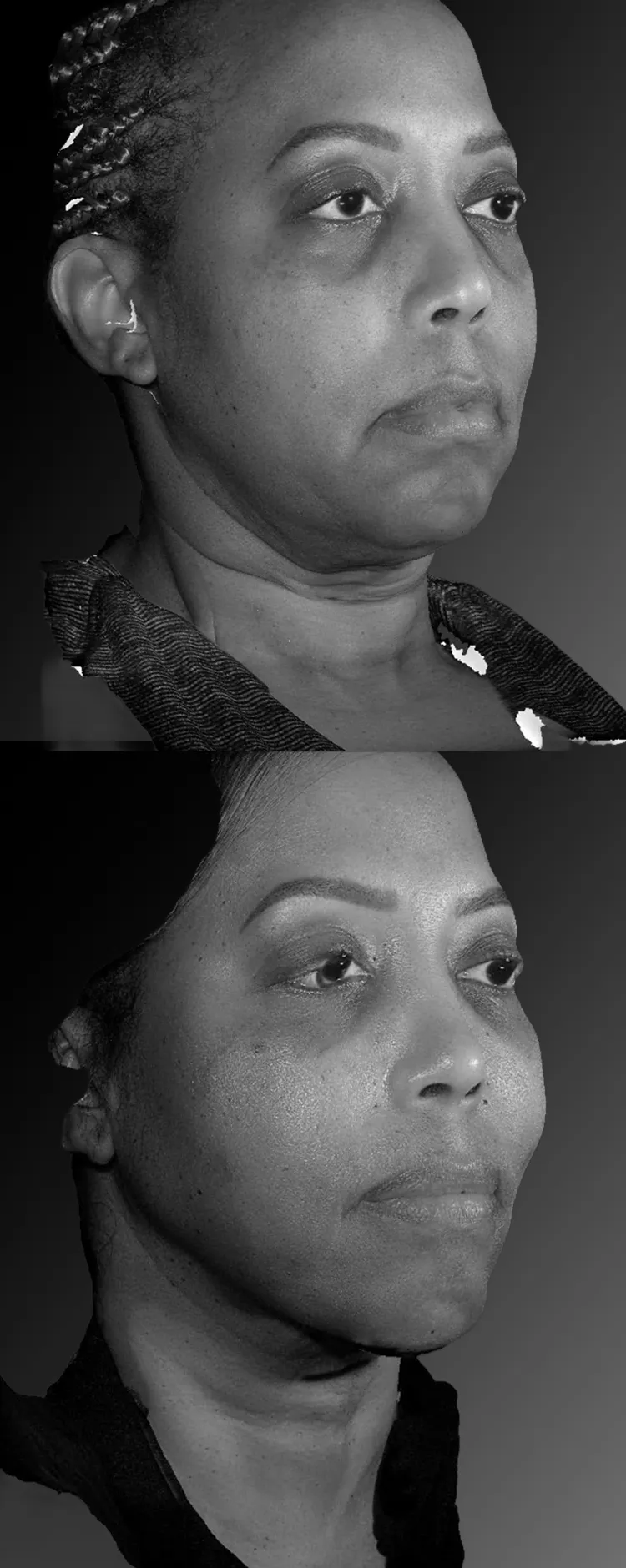 Before and after jawline and neck contour improvement showing enhanced cervicomental angle and refined facial structure