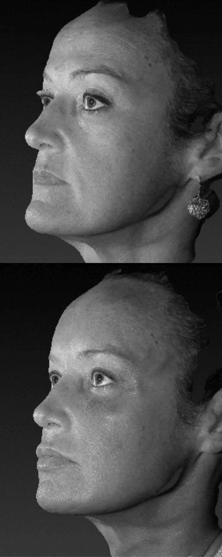 Midface Padding Face Surgery Nashville TN | Dr. Ramirez Gavidia | RG Aesthetic