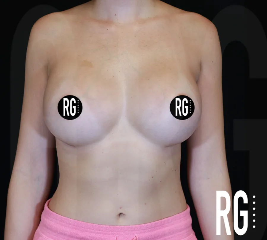 Six months after dual-plane breast augmentation with framing liposculpting by Dr. Ramirez Gavidia, Franklin TN