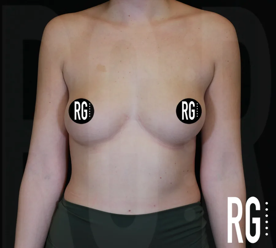 Before breast augmentation, frontal view — RG Aesthetic Plastic Surgery, Franklin TN