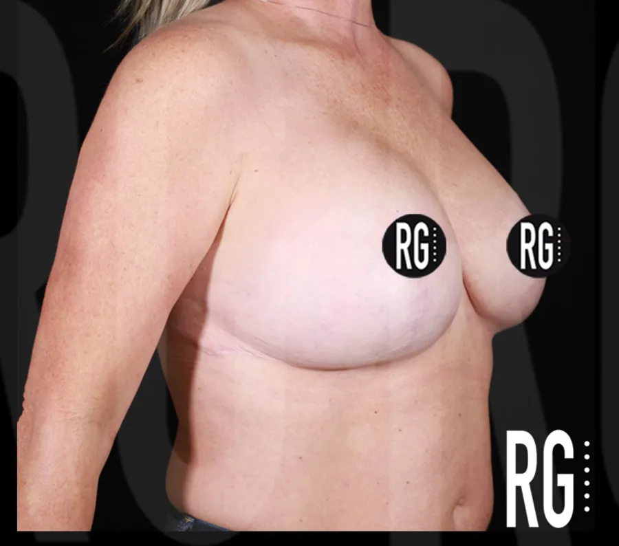 One year after structural breast lift with implants and lateral chest wall liposculpting by Dr. Ramirez Gavidia, Franklin TN