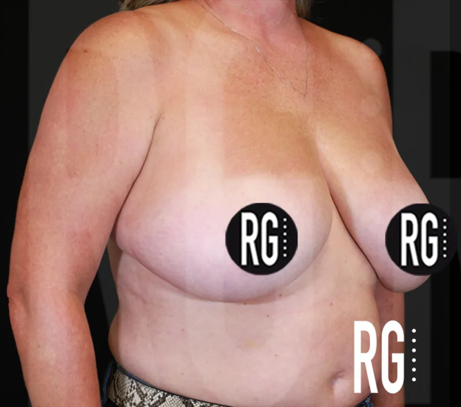 Before breast lift with implants, oblique view showing lateral chest wall fullness — RG Aesthetic Plastic Surgery, Franklin TN