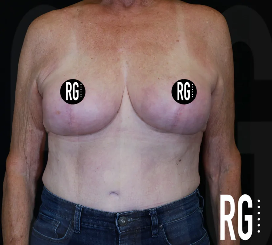 One year after structural breast reduction without implants by Dr. Ramirez Gavidia, Franklin TN