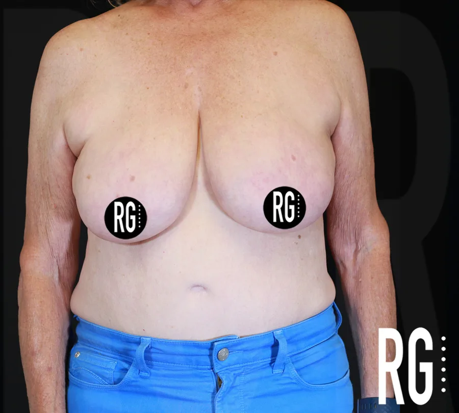 Before breast reduction, frontal view — RG Aesthetic Plastic Surgery, Franklin TN