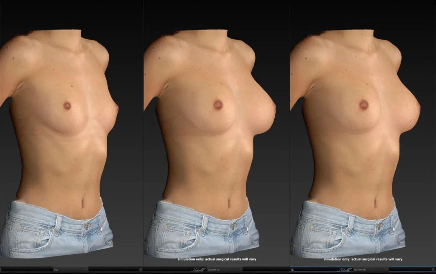 VECTRA 3D breast augmentation simulation showing implant size options on the patient’s own anatomy — RG Aesthetic Plastic Surgery